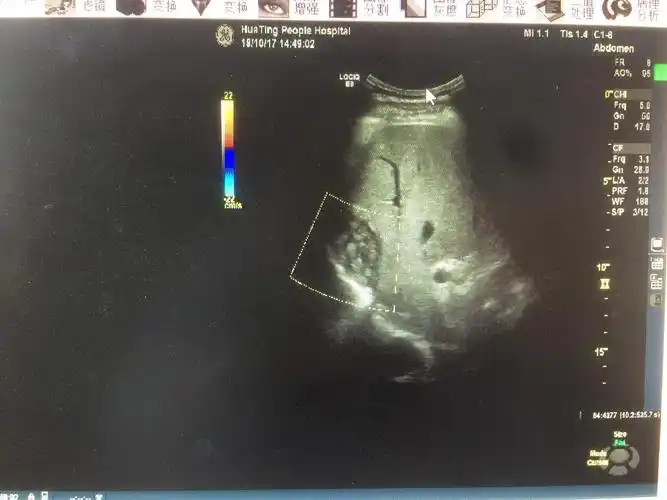 发现肝包虫,县疾控中心上报并确诊为我县域首例上报肝包虫病例.