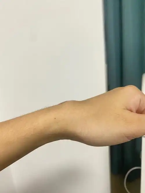 腱鞘囊肿手术不到两个月又这样了