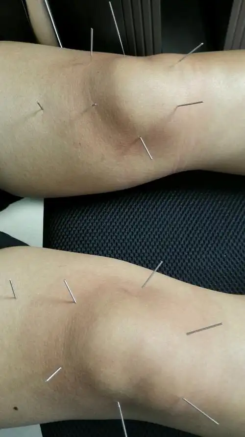 一个问题,针灸为何越扎越疼恭喜你,你可以出院了.