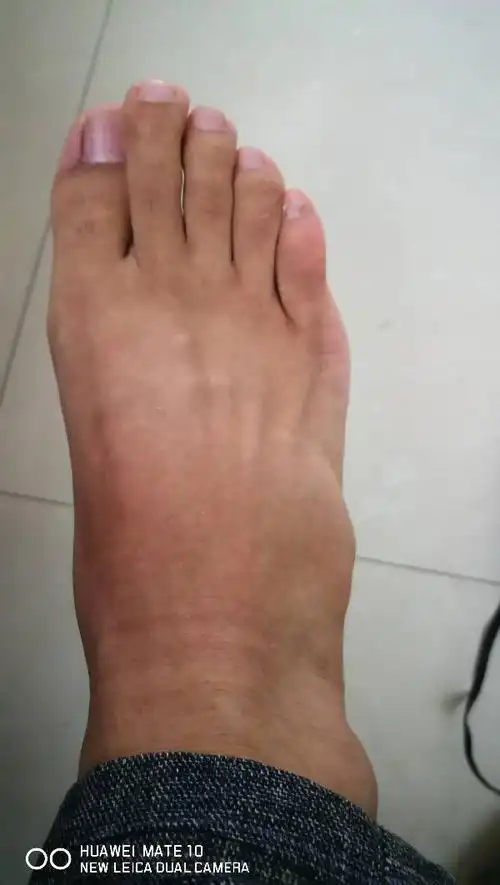 下午脚踩空了,有点扭伤,外侧边起了个核桃大的包,有没有骨科专家.