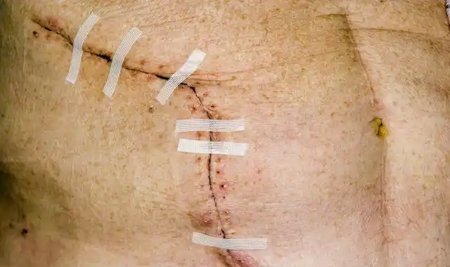 右侧卵巢囊肿手术过程全记录