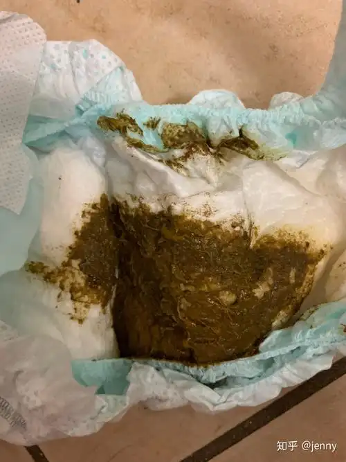 急急急孩子的便便这样的是有肠炎了吗