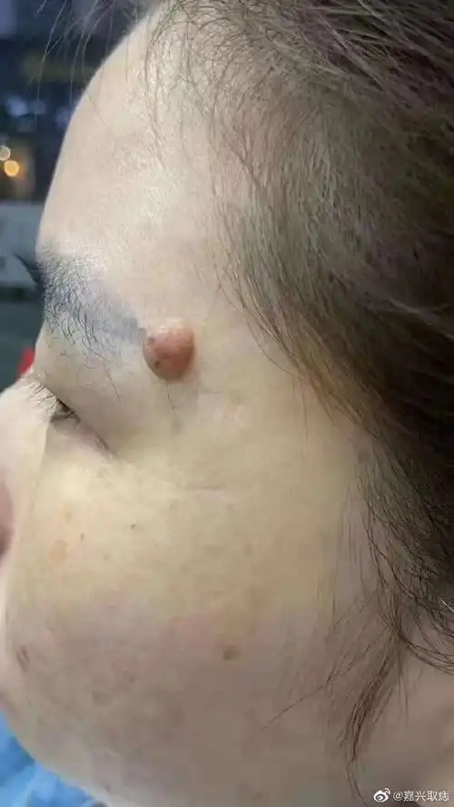 祛痣祛疣不破皮,不出血