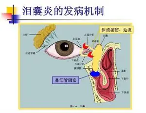 汨罗市首例鼻内镜下鼻腔泪囊吻合术