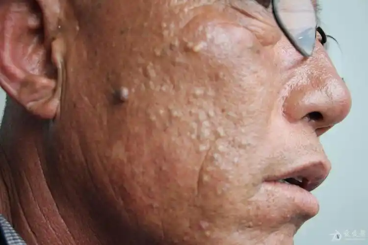 2015年皮肤版有奖病例猜答29答案老年皮脂腺增生