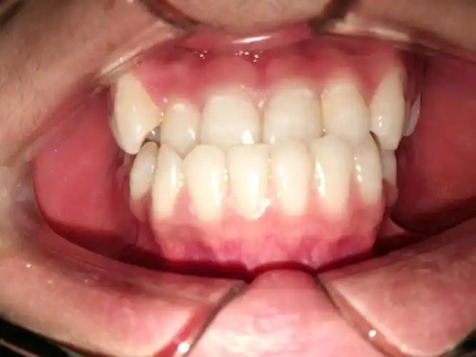 传动直丝弓矫正成人骨性反颌 - 好大夫在线