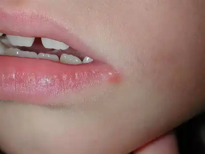 2个月内3名幼童脑死亡嘴角长这种水泡真不是上火那么简单