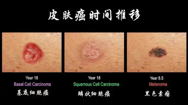 皮肤鳞癌胸膜转移用什么药好?