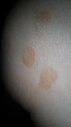 身上有这种红色的斑块是什么问题