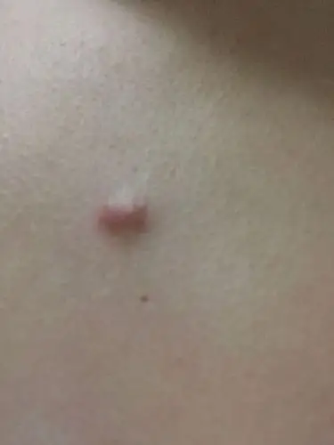 胸口中间有个硬疙瘩,黄豆粒大小,两三年了一直不下去,不疼不痒