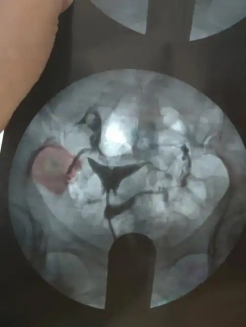 输卵管堵塞中药调理