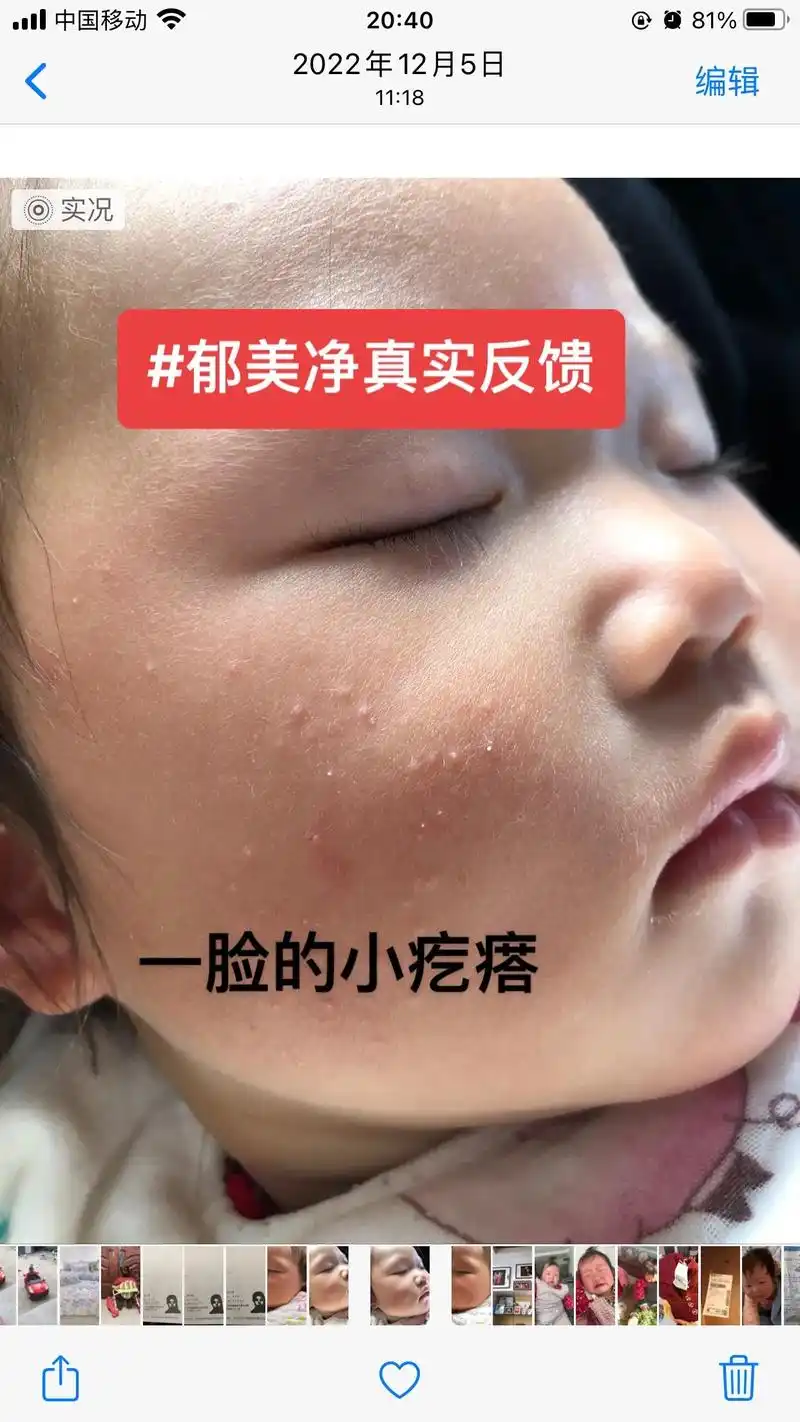 郁美净真实反馈.去年我家宝宝才几个月,脸上长小疙瘩,真的莫名 - 抖音