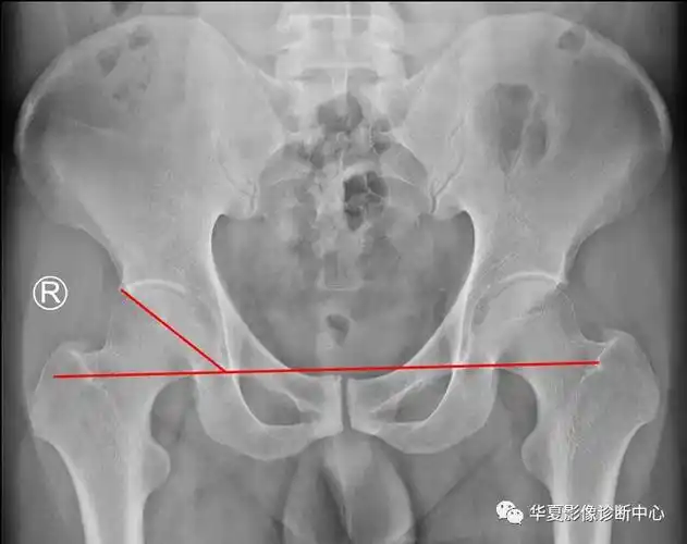 髋关节的x线测量