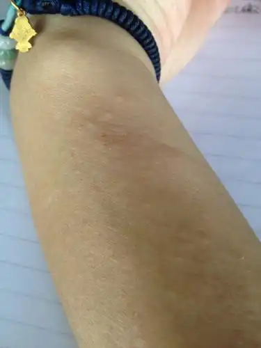 手上手臂上起这些密密麻麻的小包,有点点痒,不是很痒.起问这是什么啊?