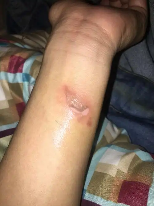 前天中午到现在烫伤的,起水泡了,今天早上水泡被弄破了(如图)现在在涂