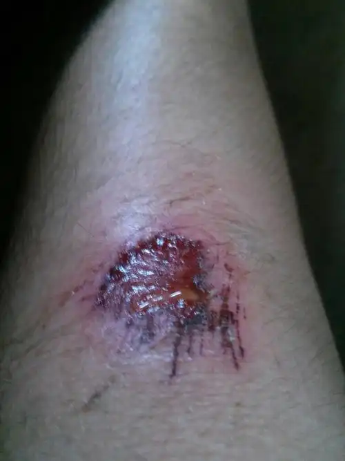 摔倒膝盖擦破出血.之前用药酒倒上去.现在算不算结痂了.