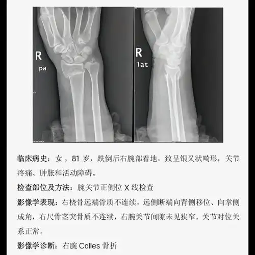 腕关节正侧位:colles骨折