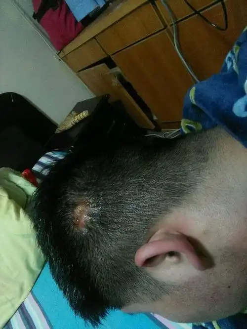 秋季男性的头皮毛囊炎图片_有来医生