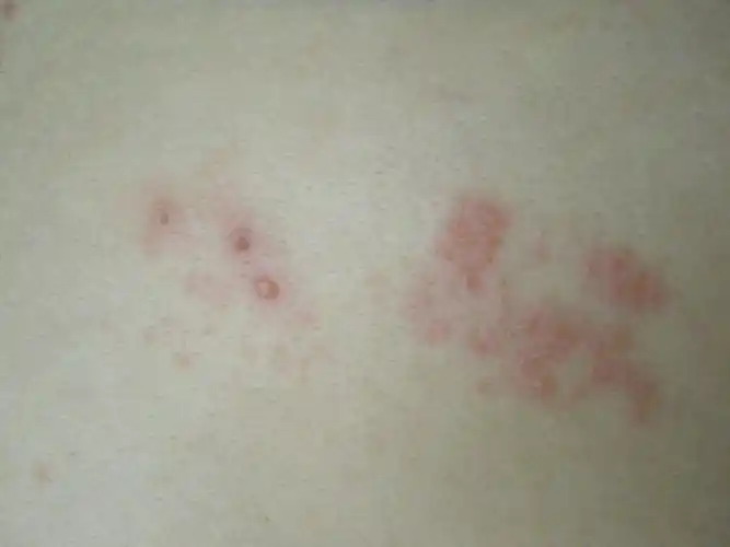 背上貌似长带状疱疹了,谁能帮我确定下吗,如果方便的话告诉我个大概