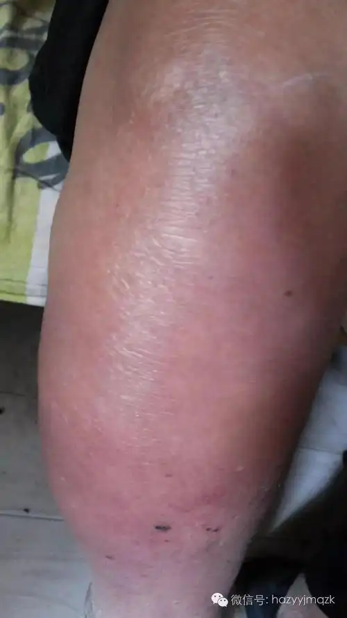 患上静脉炎的人除了有静脉肿胀这个表现外,通常还有以下症状