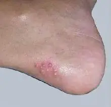 水泡型脚气怎么治