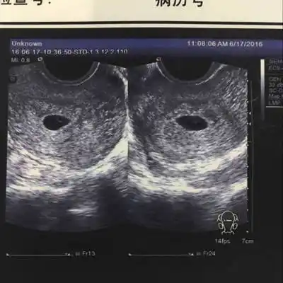 我的孕囊是长条形状还是圆形的?孕囊大小1.37*1.40*0.79cm.