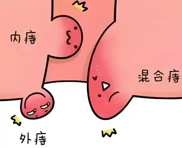 内痔和外痔的区别1,发病原因内痔的主要原因是肛门齿状线以上的静脉