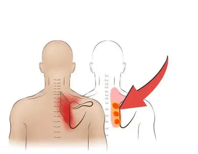 你的肩胛骨内侧也会痛吗?a)痛痛痛!b)上背部痛,不确定是不是肩胛骨.