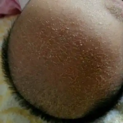 洗头后有用茶油涂第二天会好些,第三天又起了,到底什麼原因?