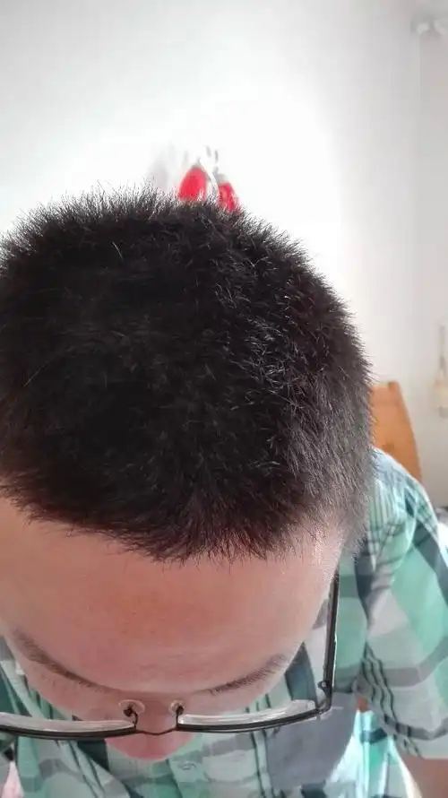 我今年18岁,男,少年白,非天生,白发越来越多,分布越来越密集,吃了一年