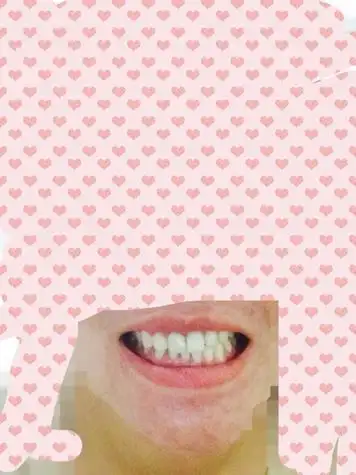 牙齿上下牙错位咬合图