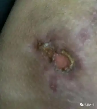 肉芽肿性小叶性乳腺炎