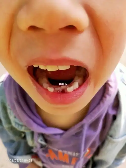 换牙焦虑,孩子恒牙萌出两颗有一颗斜着了