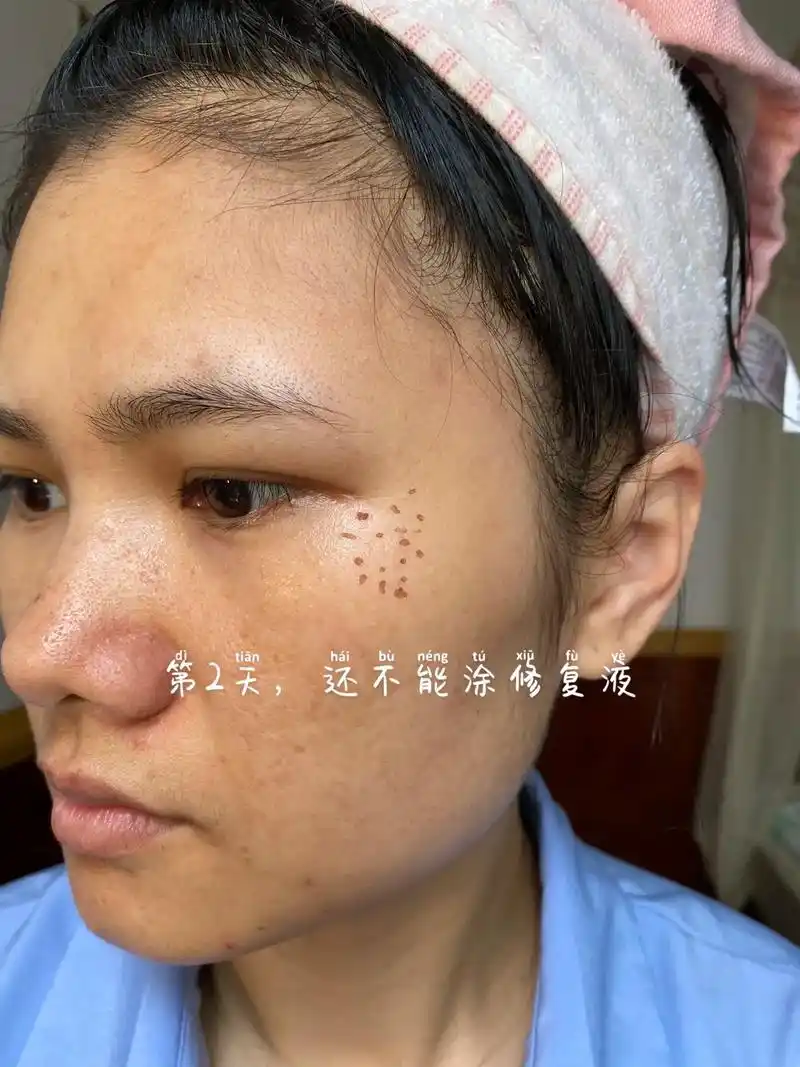 第2天,颜色加深了.今天结痂的颜色比昨天加深了,点斑的第3天 - 抖音