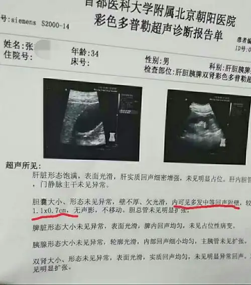 胆囊息肉患者好转病例 - 好大夫在线