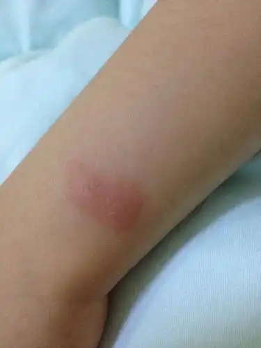 蚊子咬的包可能会是这种情况吗?