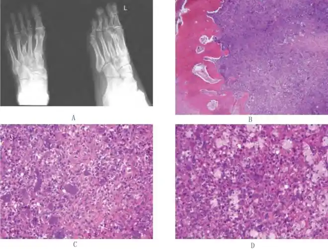 软骨母细胞瘤骨关节病理学图谱