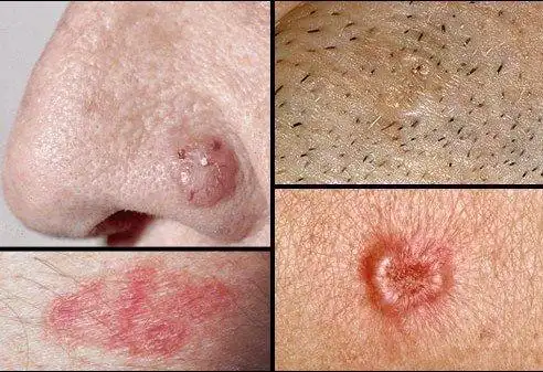 看图识病各种皮肤癌及癌前病变的不同表现