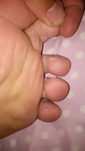 我脚爱出汗,我整天又穿着运动鞋上班,现在脚就成这样了,有没有人有