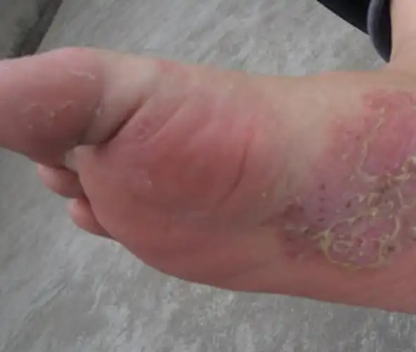 j525脚上慢性湿疹图片
