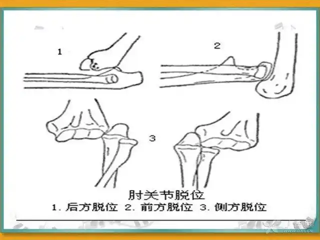肘关节脱位的分型与治疗