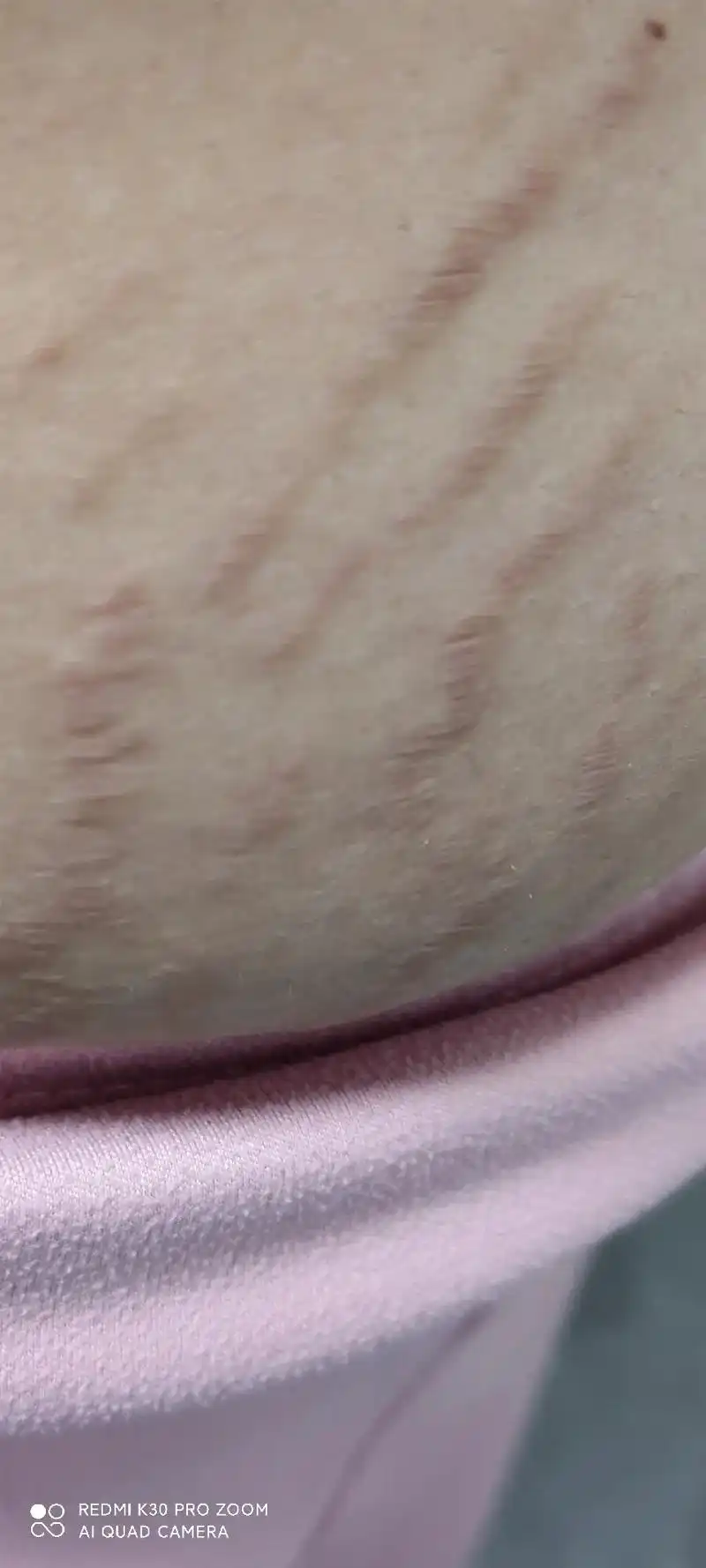 妊娠纹从小腿内测长到大腿,肚子,93部,衣服从m码穿到xl码 - 抖音