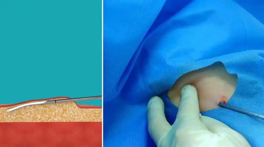 左炔诺孕酮皮下埋植剂植入介绍