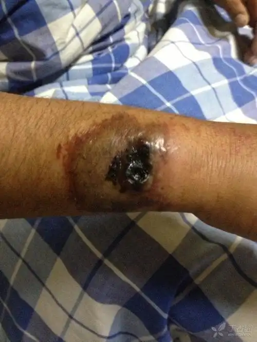 典型皮肤炭疽一例