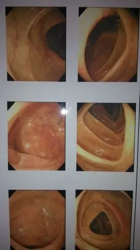 我老婆肚子疼了一年多了,上个月到医院检查做了肠镜