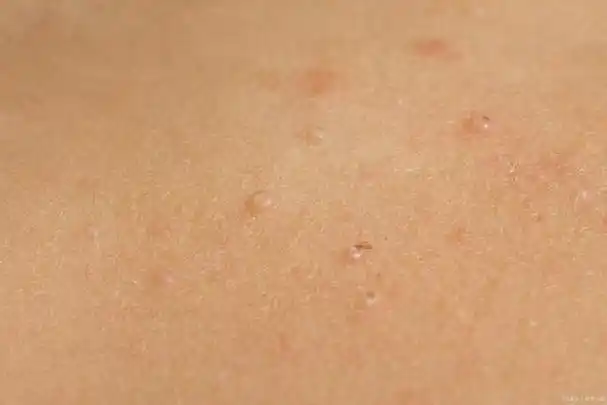 扁平疣是一种常见的皮肤疾病,常见于青少年和儿童身上.