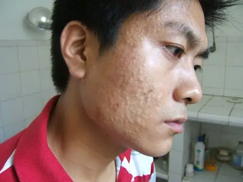 典型的白头粉刺,请欣赏