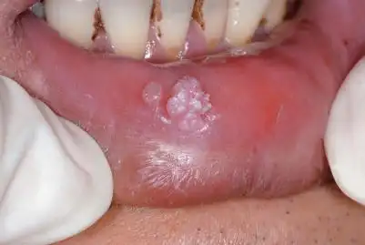 靠右者为正常黏膜颜色;靠左者发白,表面粗糙,见较多细小突起呈菜花状