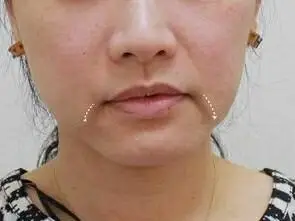 你真的不在意脸上的三八线吗?