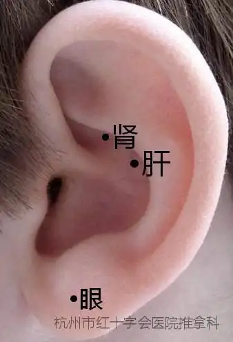 假性近视的手段之一,将王不留行籽贴于患者耳部的特定穴位,一般取穴肝